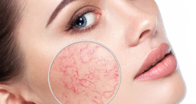 Redness Control Classis - Tschüss Hautrötungen!